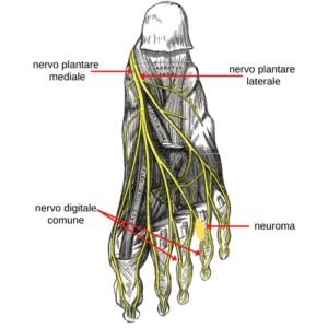 neuroma di morton intervento
